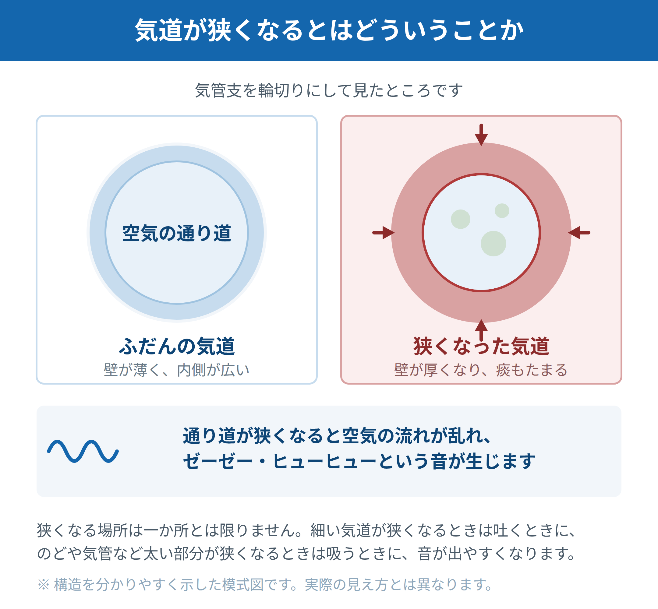 気管支を輪切りにした断面の模式図。ふだんの気道は壁が薄く内側が広いのに対し、狭くなった気道では壁が厚くなり痰がたまり、空気の通り道が狭くなっていることを比較して示している。